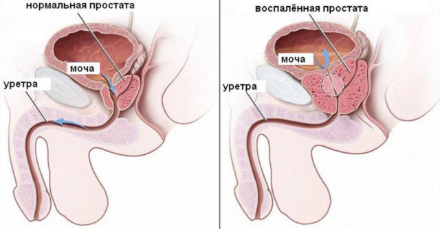 Prostatitis Alomatlari)
