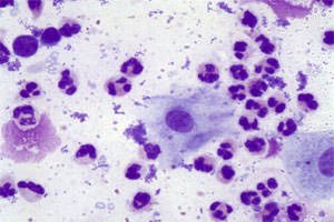 A staphylococcus epidermidis prosztatagyulladás